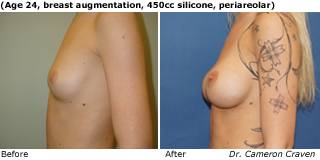 patient e breast augmentation side