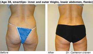 Patient C SmartLiposide view Before and After
