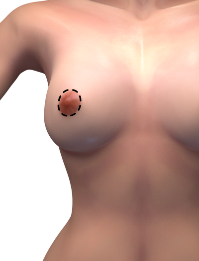 circumareolar breast lift