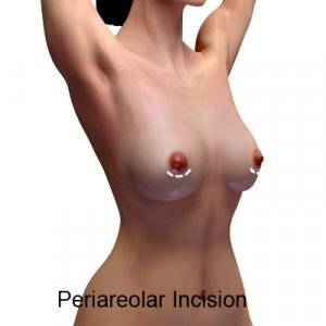 periareolar incision