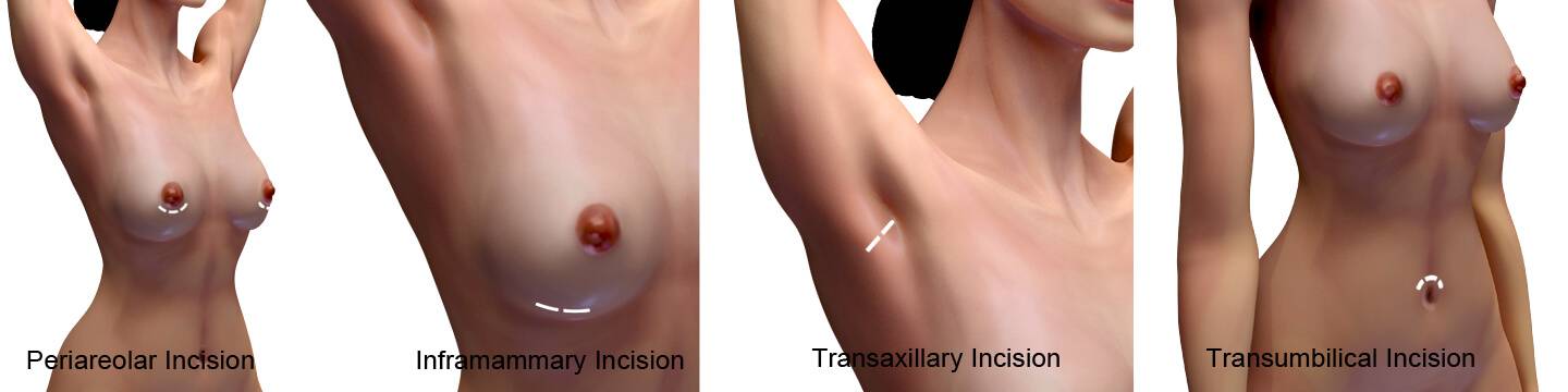 breast augmentation incision