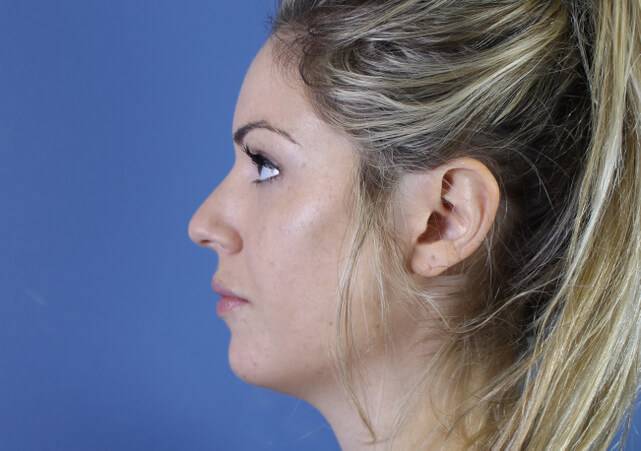 after restylane defyne