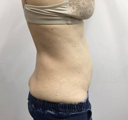 coolsculpting side after