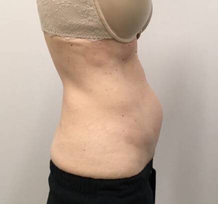coolsculpting side before