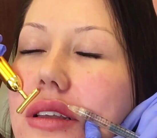 dermal filler