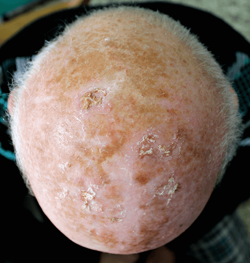 Actinic Keratosis