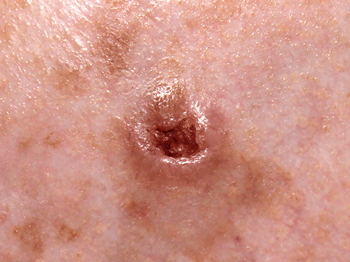 Basal Cell Carcinoma