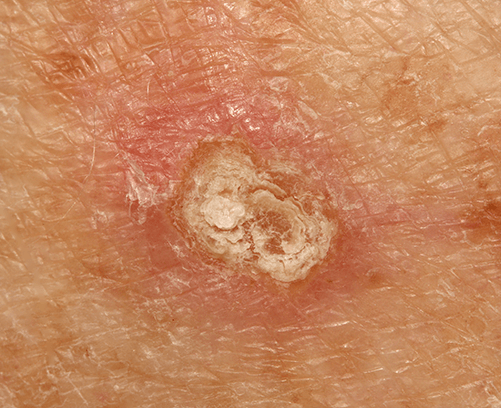 Squamous Cell Carcinoma