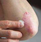 psoriasis symptom triggers