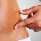 tummy tuck scar
